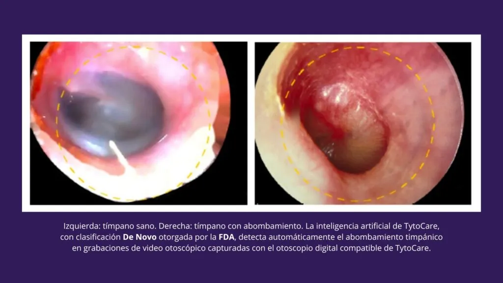 Material de TytoCare sobre análisis asistido de video otoscópico